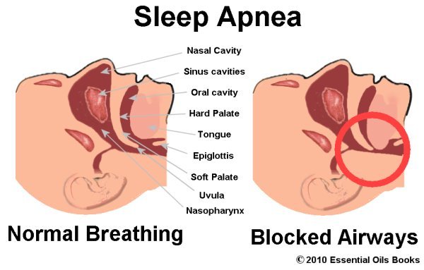 Sleep-Apnea